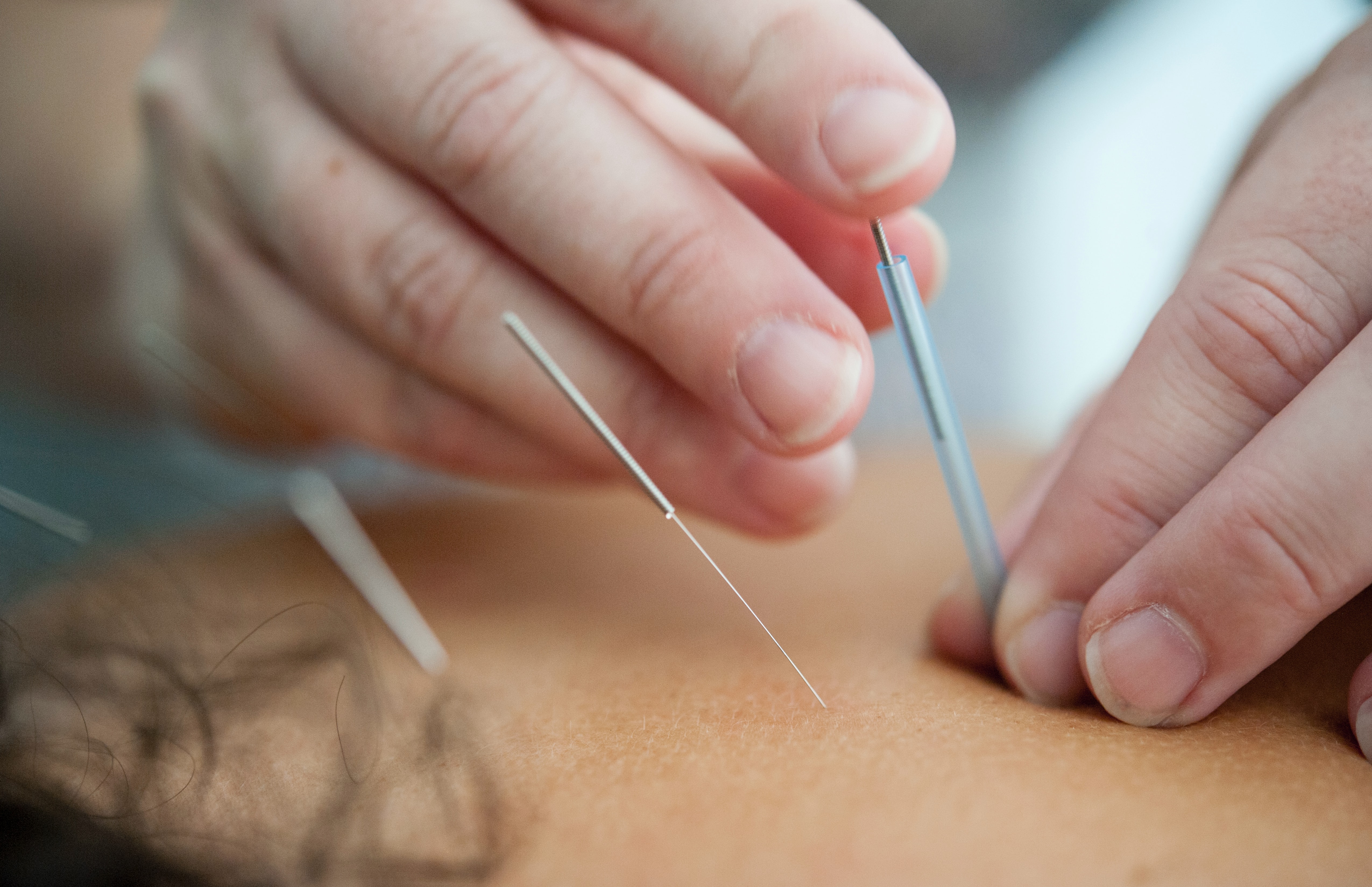 Can you acupuncture yourself?