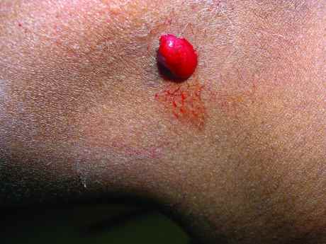 Bleeding skin tag