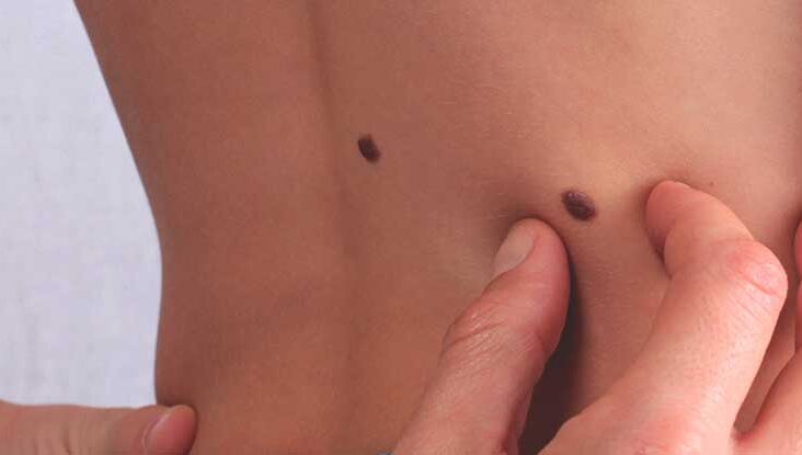 What to Do When a Skin Tag Turned Black
