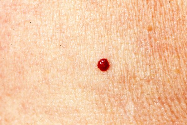 How to Stop Your Cut-off Skin Tags from Bleeding?