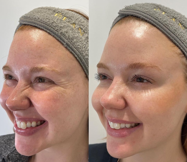 Before and after ELAN Aesthetics Botox treatment of a woman