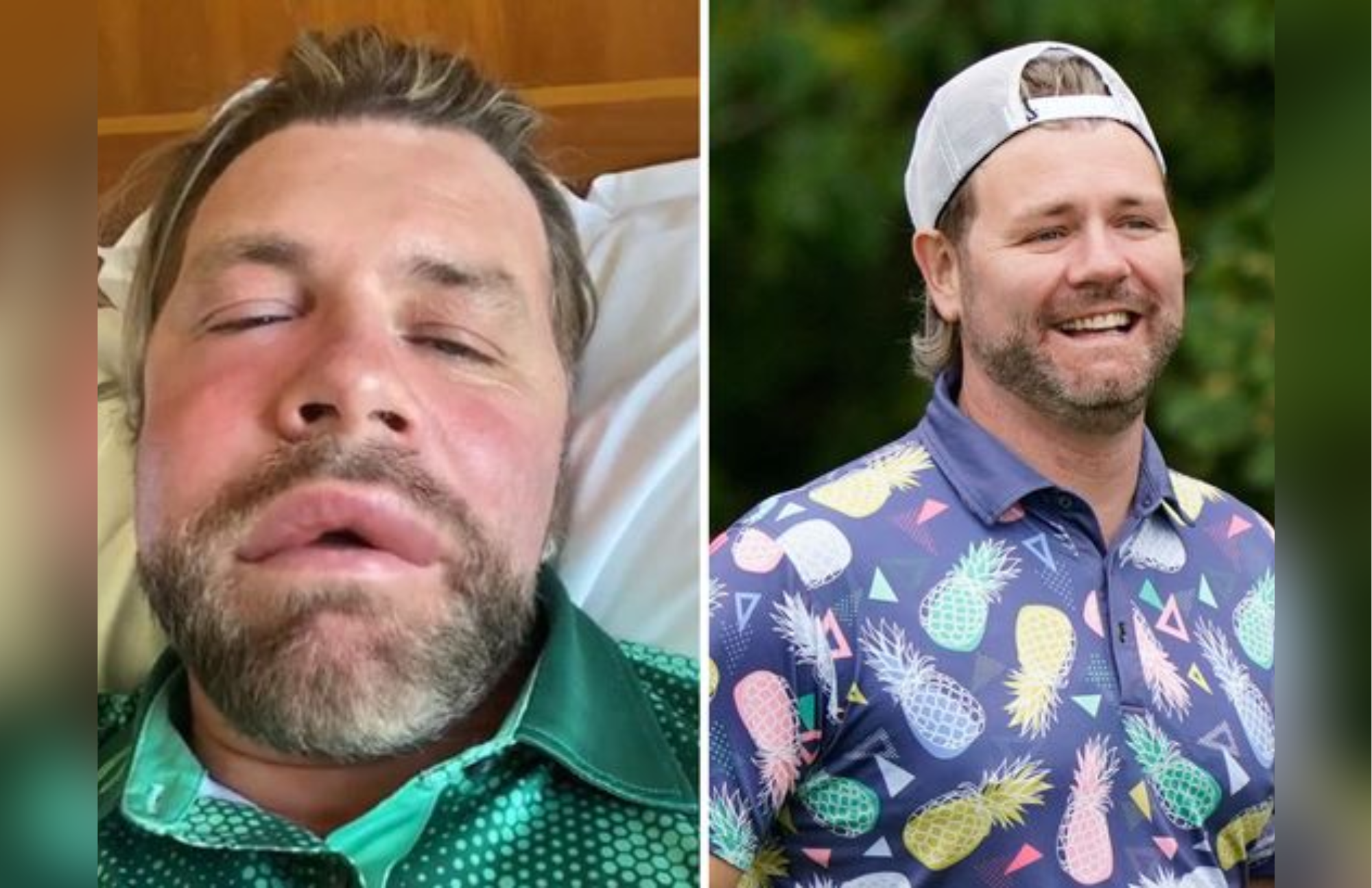 Former Westlife Member's Face Becomes Unrecognizable Due To Bee Stings
