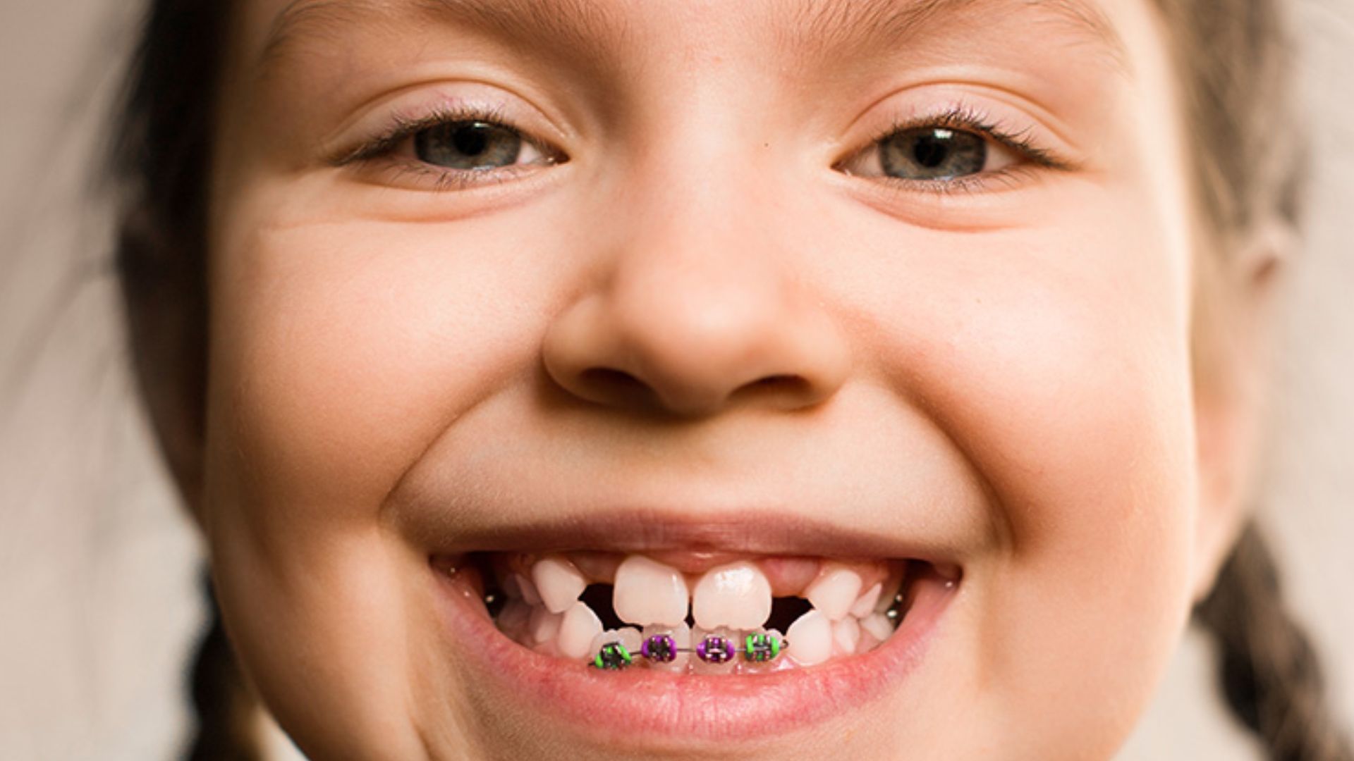 Kid Showing Her Broken Teeth
