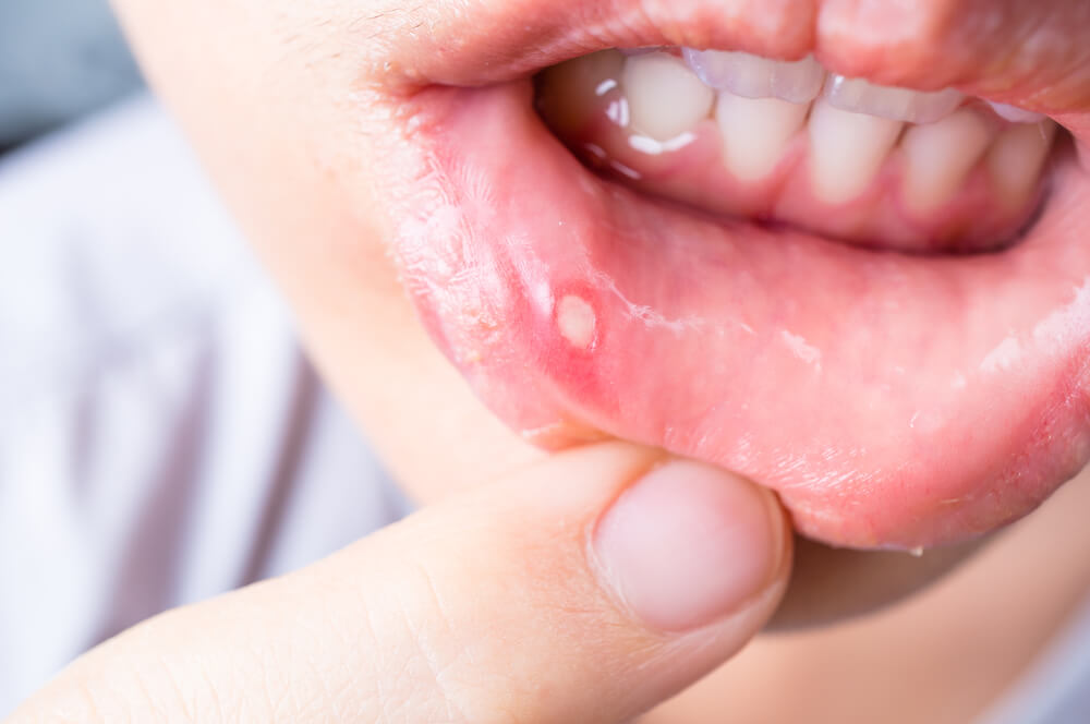 Treatment For Mouth Ulcers - How To Get Rid Of Mouth Ulcers Easily
