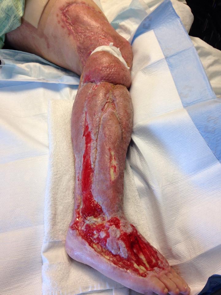 A leg that has a severe infection