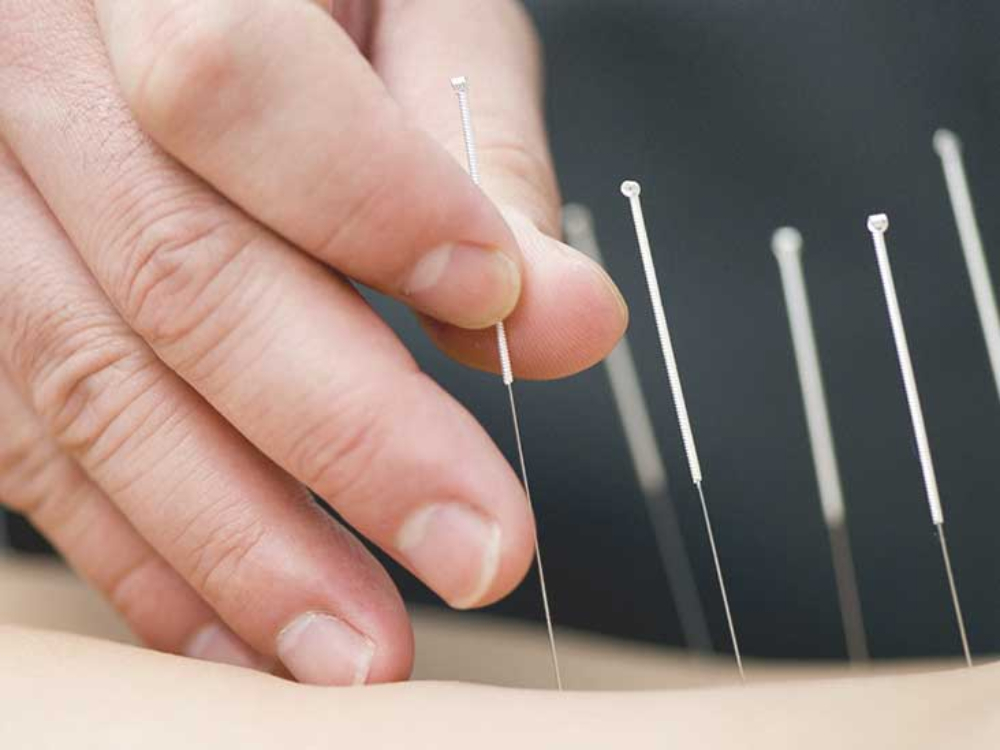 Does Acupuncture For Spinal Injury Help In Quicker Healing?