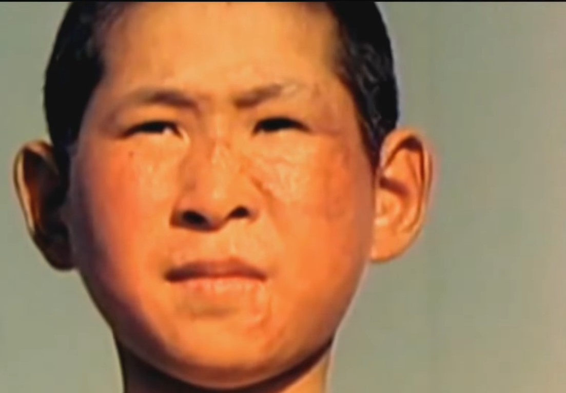 A Japanese boy with only half of his eyebrows and a visible scar across his face