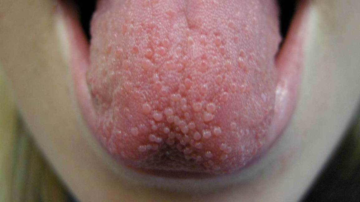Tongue warts