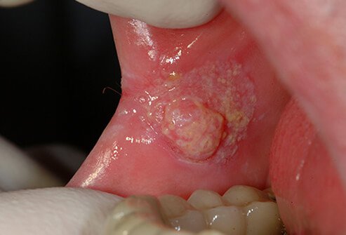 Human papillomavirus hpv on tongue