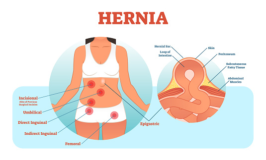 Vector diagram of a woman with parts of belly labelled and zoomed section of the hernia