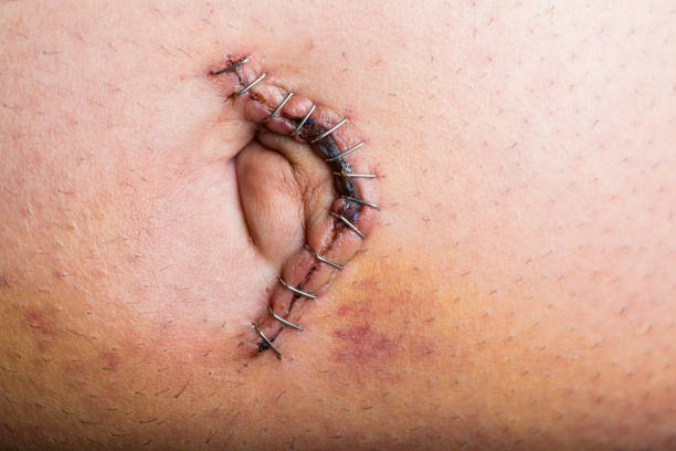A wound around the belly button is stitched.