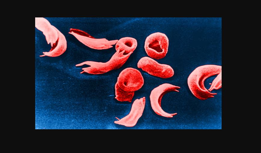 Red blood cells from an individual with sickle cell disease