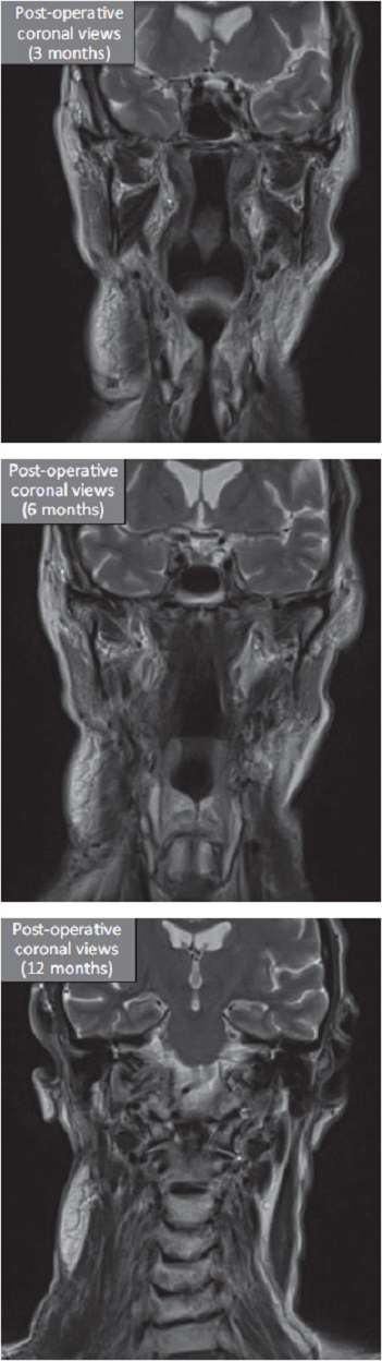 Two MRI results showing post-operative coronal views after three months and after six months