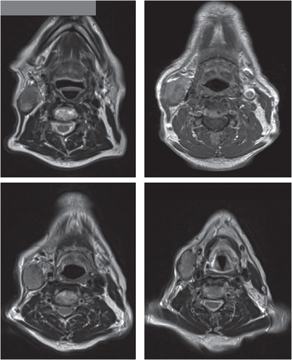 Four MRI results of the radiation-induced high-grade spindle cell sarcoma of the sternomastoid muscle
