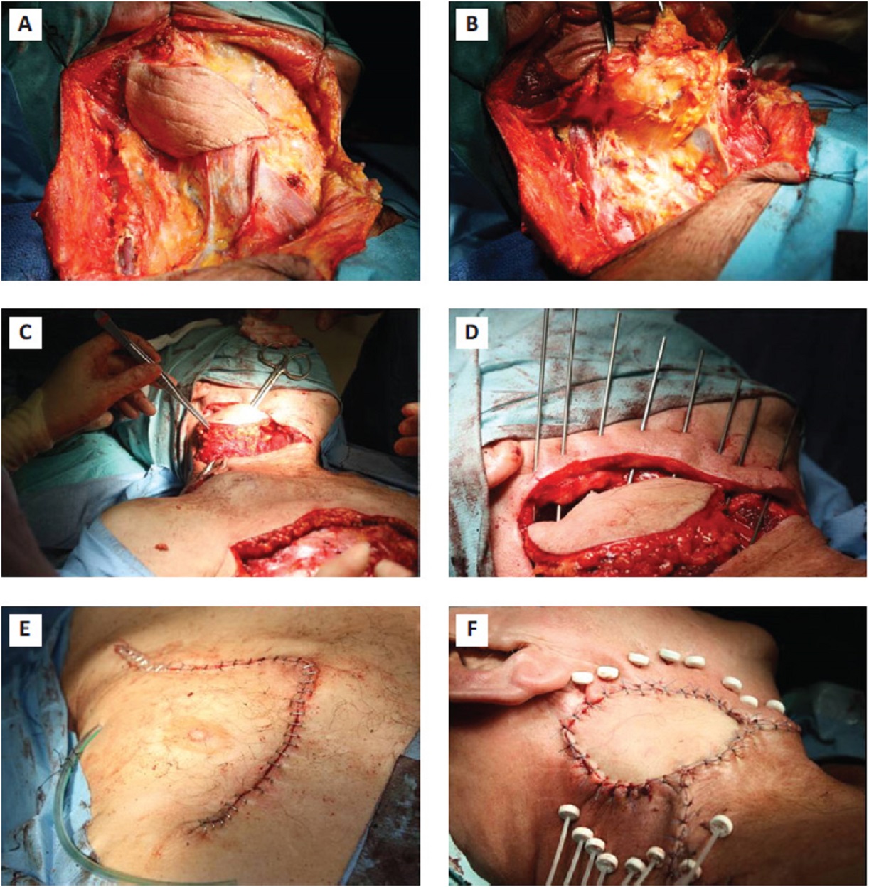 Exposed human flesh during neck surgery, inserted catheters and post-surgery stitches